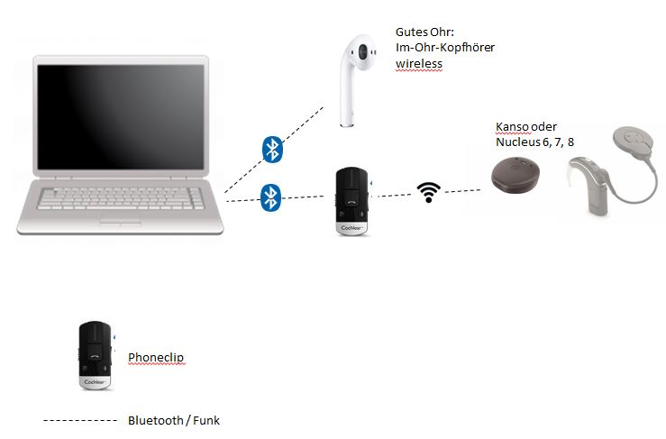 Datei:Stereohoeren Cochlear SSD2.png