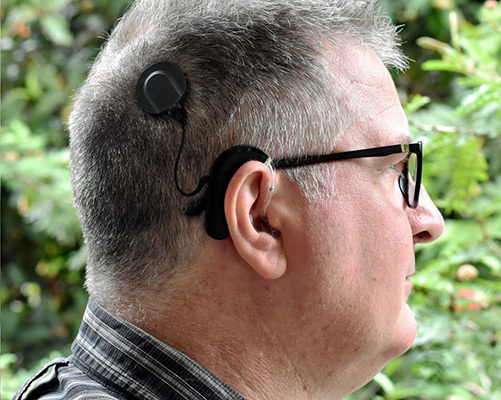 Datei:Cochlear implant user.jpg