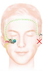 Knochenleitungsimplantat Cochlear BAHA System. Quelle: Cochlear Presseportal, Nutzung für Informationszwecke gestattet.