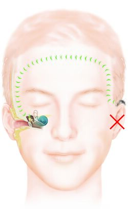 Abgebildet ist ein Beispielbild eines perkutanen Knochenleitungsimplantats (BAHA) von Cochlear. Dabei sind der innere Teil dargestellt, der das System und den Einbau visualisiert