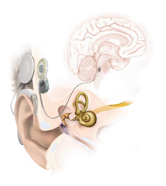 Datei:Anatomie Hirnstammimplantat ABI MED-EL.jpg