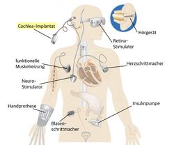 zu sehen sind verschiedene, mögliche metallische Implantate im Körper - von Kopf bis Fuß. Von Retina-Stimulator, Hörgerät, Cochlea-Implantat, Herzschrittmacher, bis Handprothese, Blasenschrittmacher und Insulinpumpe