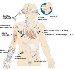 Anatomie eines Menschen und abgebildete Geräte, die an den jeweiligen Stellen als Implantat eingebaut sind