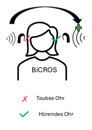 Grafik mit Kopf, der auf einer Seite ein rotes Kreuz an Stelle des Ohrs hat, das die Taubheit symbolisiert. Auf der anderen Seite ein grünes Häkchen, das das gute Ohr symbolisiert und ein Plus, das die Signalverstärkung symbolisiert. Ein Pfeil vom Kreuz zum Häkchen.
